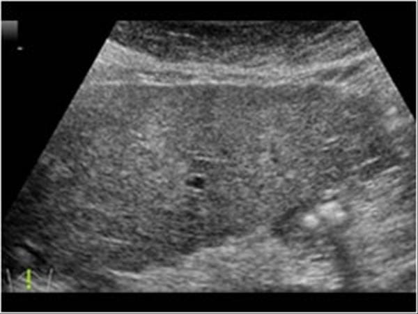 Abdomen and retroperitoneum | 1.1 Liver : Case 1.1.12 Cirrhosis and portal hypertension | Ultrasound Cases