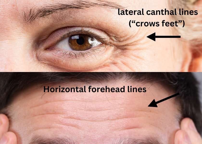 photo illustrating lateral canthal lines and horizontal forehead lines that may now be treated with Xeomin product