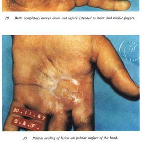 Mutant people in Brazil with Frame Shifted DNA caused by Cesium Gamma Radiation