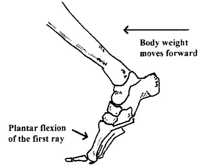 Plantarflexed First Ray | DRHC Dubai Foot and Ankle Clinic