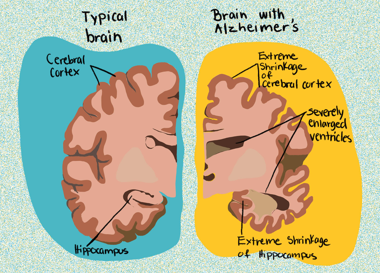 The illustration shows a brain divided in half. On the left side, under the label "typical brain" we see a rough sketch of a brain, with arrows pointing to "cerebral cortex" and "hippocampus" within the sketch. On the right side, under the label "Brain with Alzheimer's" we see the same brain sketch, but this time it is significantly smaller and slightly shriveled, indicating the brain shrinking typical with Alzheimer's. The right-side brain includes labels like "extreme shrinkage of cerebral cortex," "severely enlarged ventricles," and "extreme shrinkage of hippocampus." The illustration shows a brain divided in half. On the left side, under the label "typical brain" we see a rough sketch of a brain, with arrows pointing to "cerebral cortex" and "hippocampus" within the sketch. On the right side, under the label "Brain with Alzheimer's" we see the same brain sketch, but this time it is significantly smaller and slightly shriveled, indicating the brain shrinking typical with Alzheimer's. The right-side brain includes labels like "extreme shrinkage of cerebral cortex," "severely enlarged ventricles," and "extreme shrinkage of hippocampus."