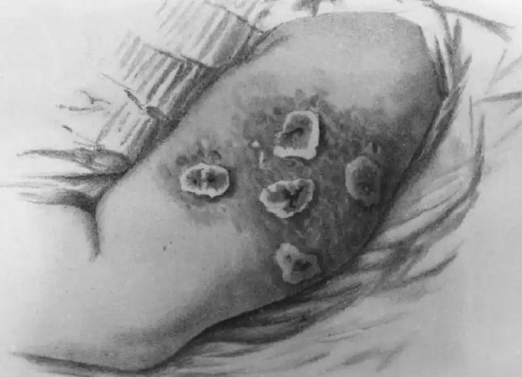 smallpox vaccines injury