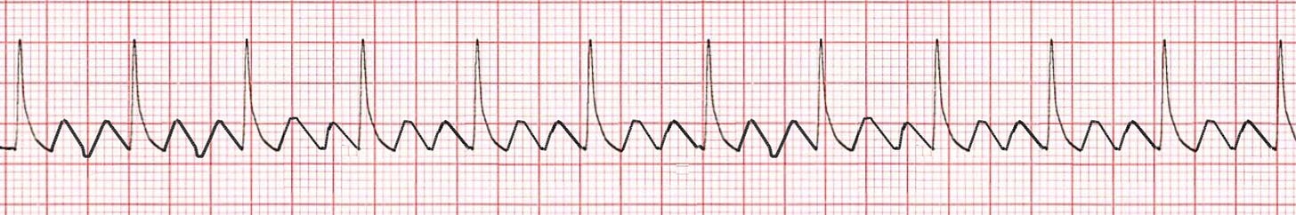 Atrial Flutter training - ACLS Cardiac Rhythms video | ProACLS