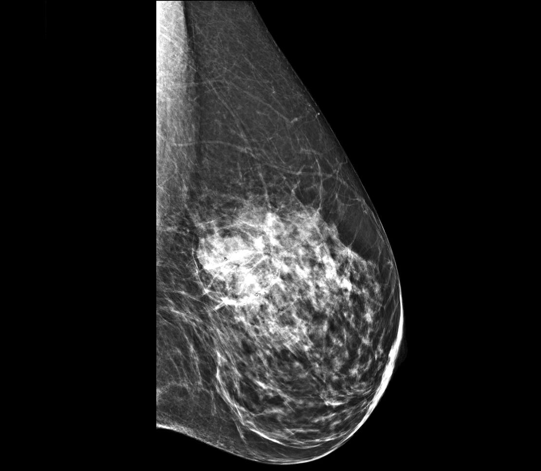 Mammogram of left breast Mammogram of left breast