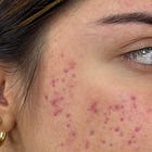 I surveyed ~7,000 hormonal acne sufferers + the results will shock you