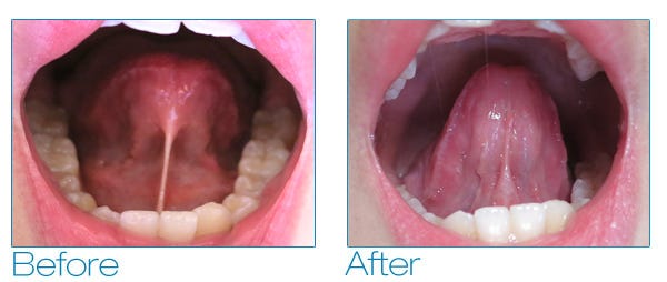 Tongue-Tie (Ankyloglossia) - Thornhill, Vaughan, Richmond Hill Dentist