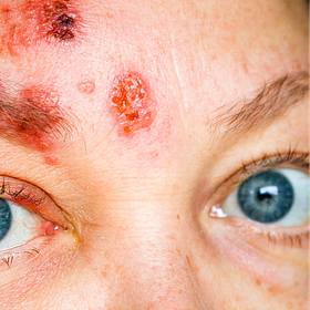 Shingles caused by Pfizer Jabs - Endotoxin or Spike?