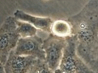 English: Cancer cells photographed by camera a...