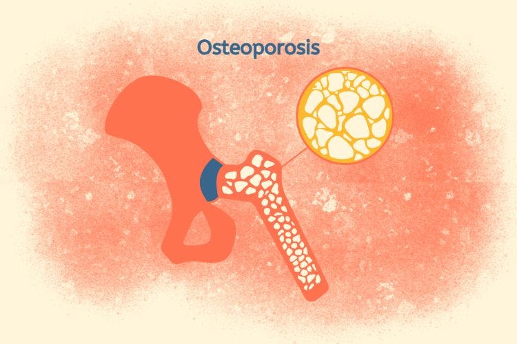 Osteoporosis