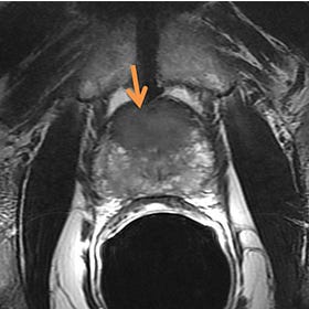 Case Report: Metastatic Prostatic Adenocarcinoma, age 77, Male