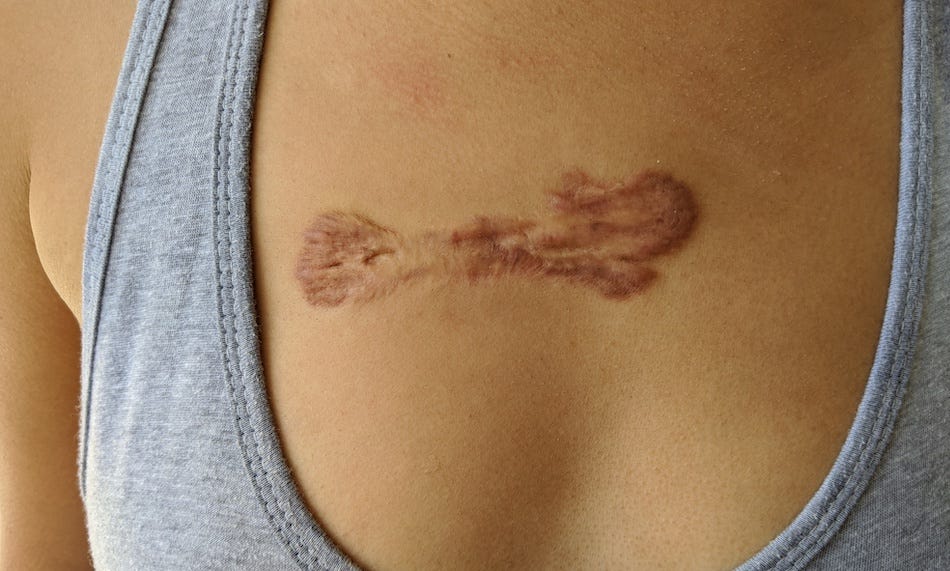 chest keloid after third injection schimiggy chest keloid after third injection schimiggy