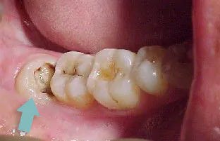 Decayed impacted wisdom tooth