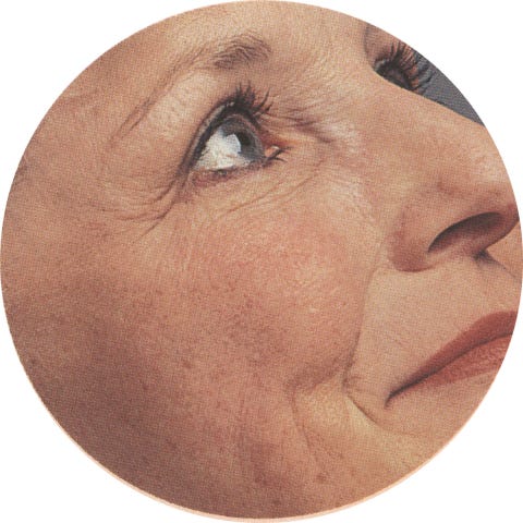 Paciente com classificação Glogau tipo III já em um estágio mais avançado de envelhecimento. 