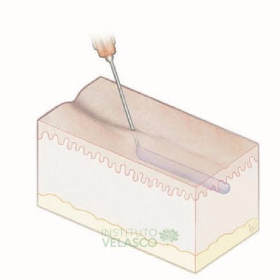 preenchimento em linha, linear preenchimento em linha, linear