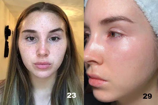 Will retinol fade your freckles?