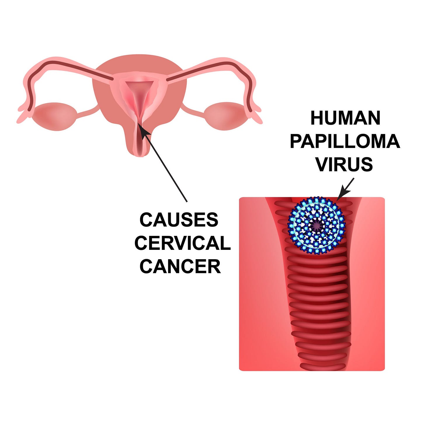 Illustration af HPV-virus og dens biologiske kobling til livmoderhalskræft., AI-genereret