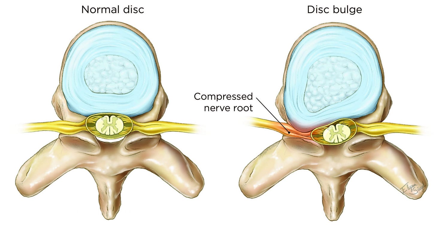 Herniated Disc - Goodman Campbell