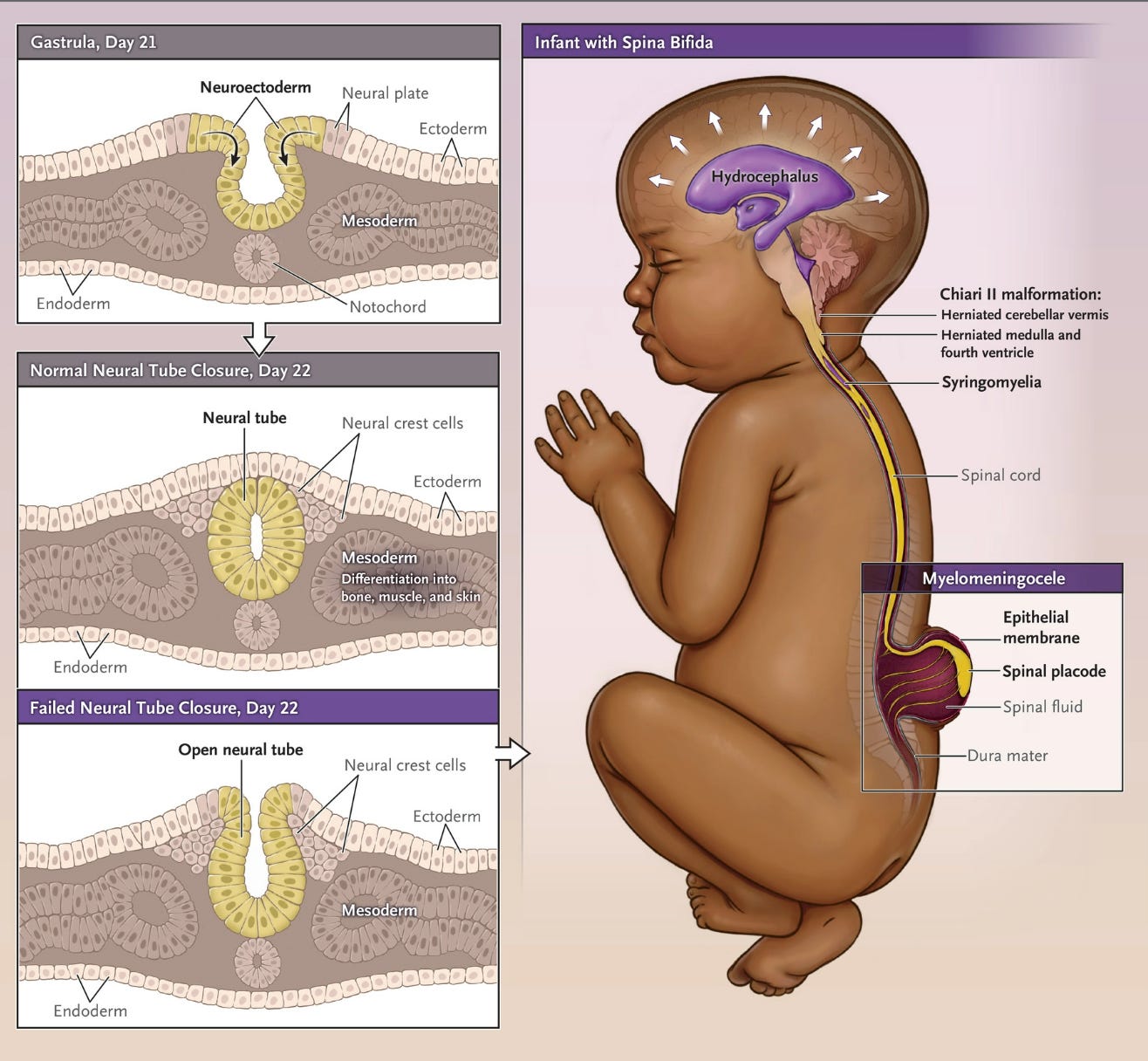 Spina Bifida Part 1 - by Ron Litman