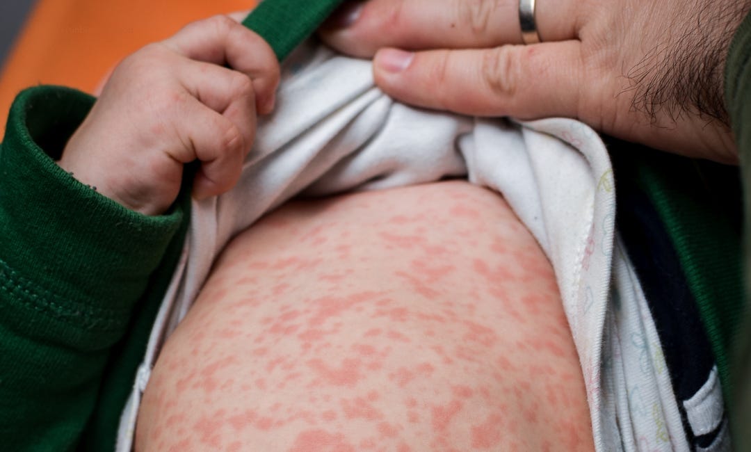 Measles is NEVER (ever!) Beneficial