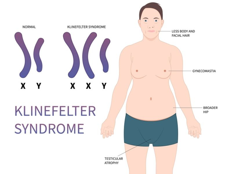 Klinefelter Syndrome- Symptoms, Causes, Treatments, & More