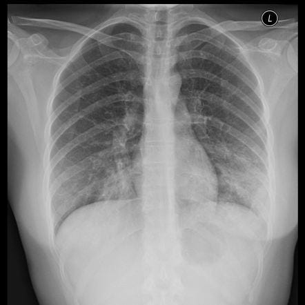 Mycoplasma pneumonia | Radiology Reference Article | Radiopaedia.org