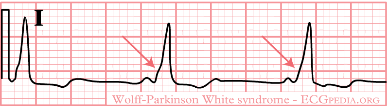 The Delta wave