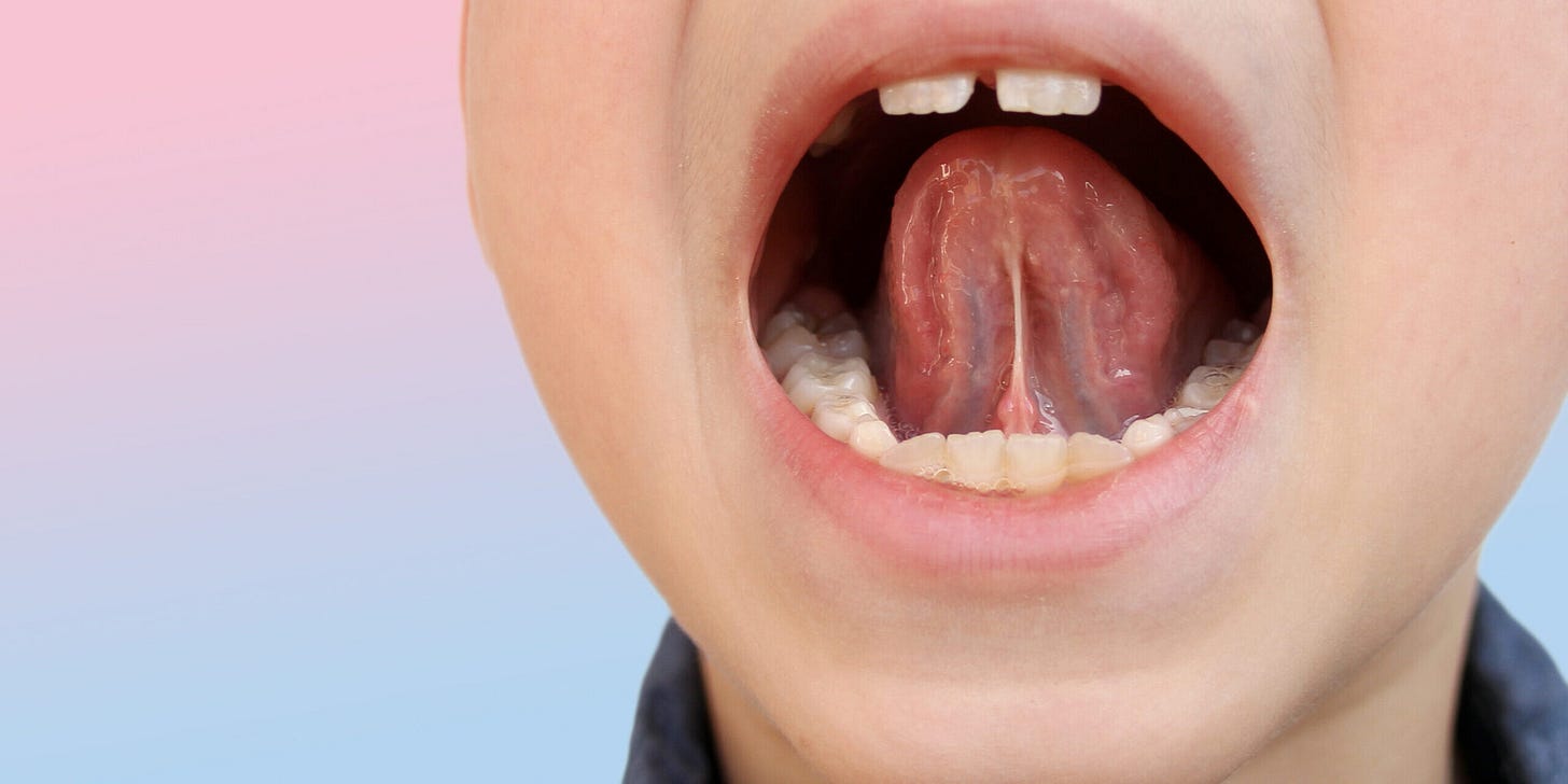 Myofunctional Therapy/Tongue Exercises for Sleep Apnea - Rockland Dental  Specialists
