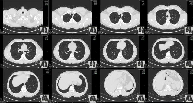 Downloading and Preprocessing Medical Images in Bulk: DICOM to NumPy with  Python – Glass Box