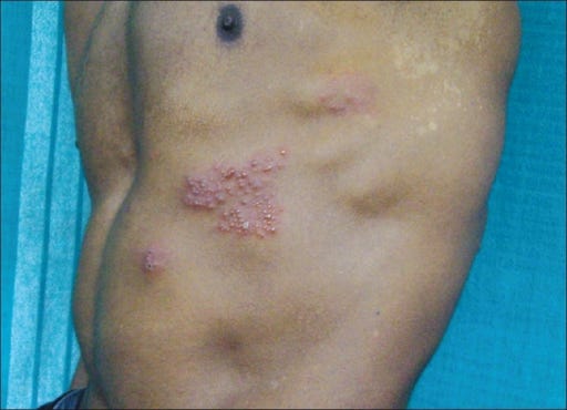You might have shingles if you have a blistering, painful rash that is limited to a few narrow bands (dermatomes) on one side of your body, especially if you haven’t had your shingles vaccine yet. You might have shingles if you have a blistering, painful rash that is limited to a few narrow bands (dermatomes) on one side of your body, especially if you haven’t had your shingles vaccine yet.