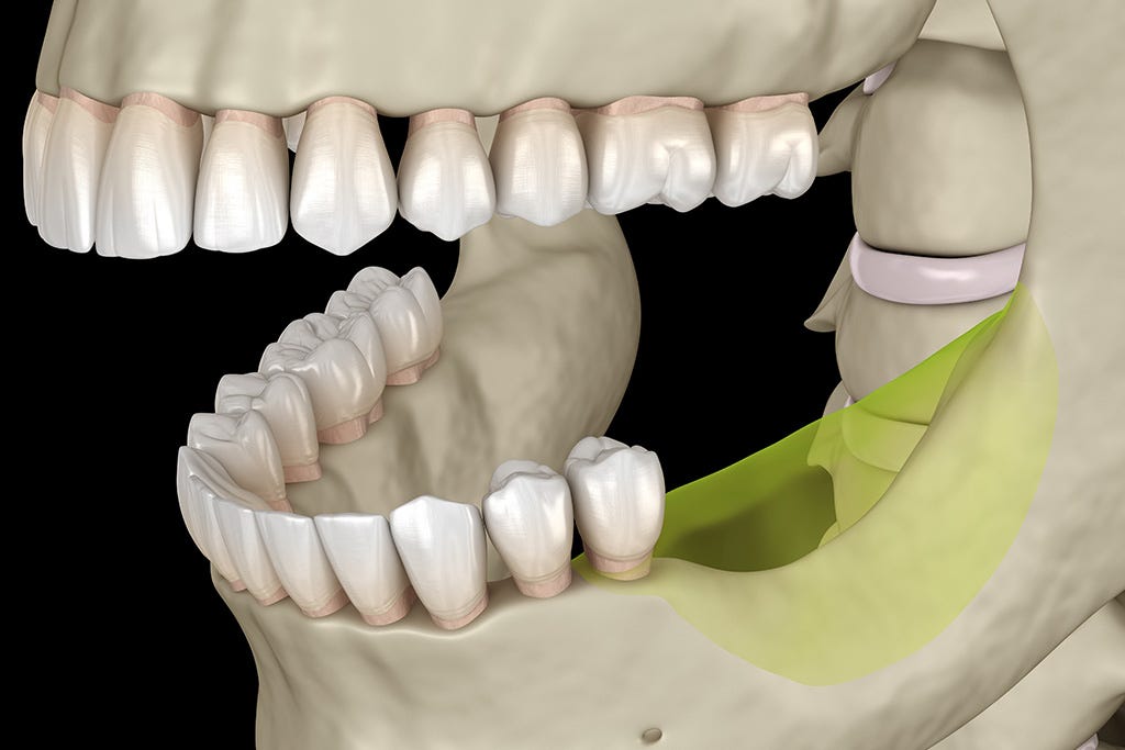 Best Options to Replace Missing Teeth (A Complete Guide)