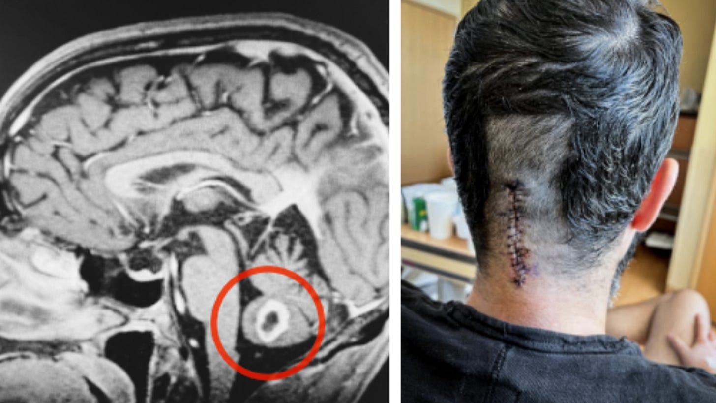 A brain MRI scan shows a circled abnormality, while a person with a fresh surgical scar on the back of their head—whose journey highlights the gift of consciousness—sits facing away from the camera.