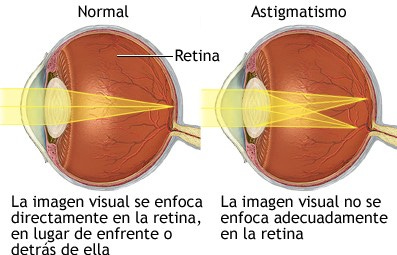 Astigmatismo