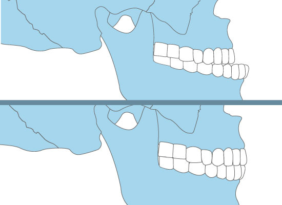 Class 3 Malocclusion Treatment With Clear Aligners (Treatment Plan, Case  Study & Conclusions)