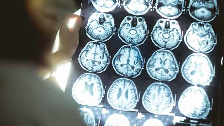 posterior cortical atrophy alzheimers