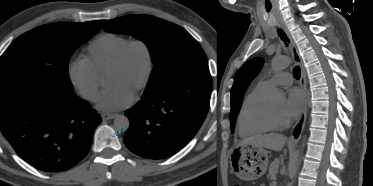 Case 54: Multiple Bone Lesions