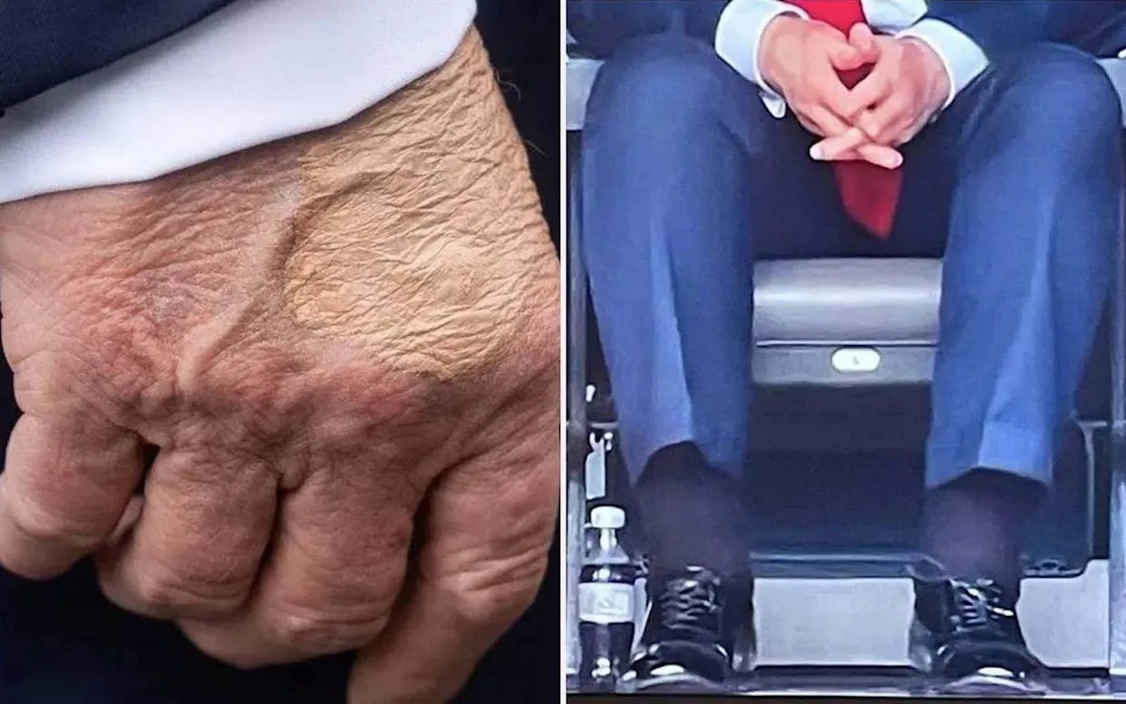 Trump's swollen ankles caused by chronic vein condition, White House ...