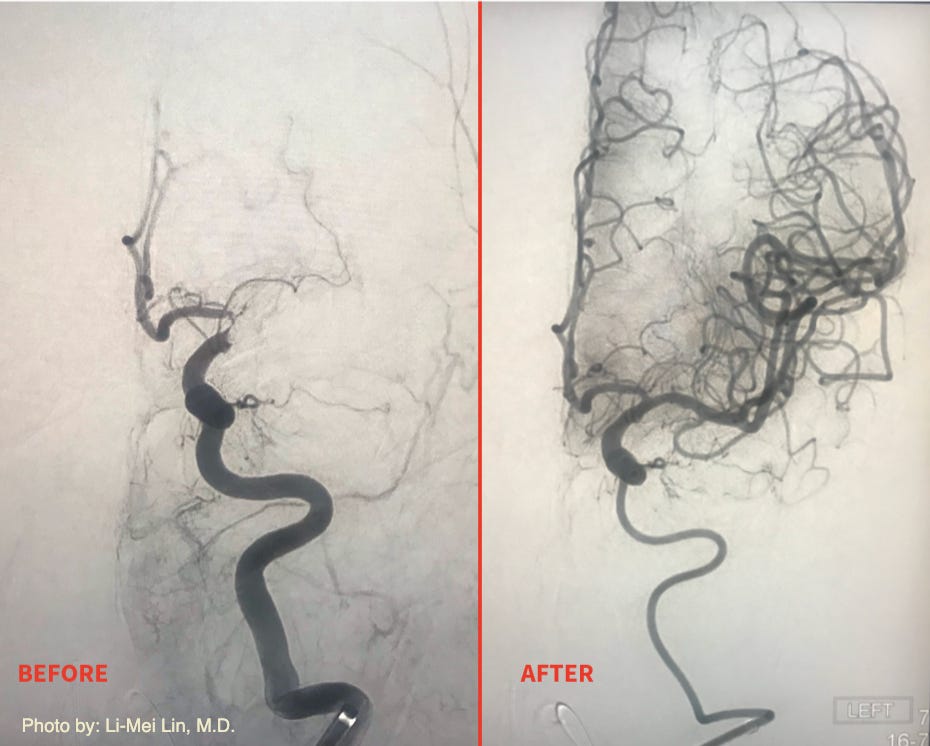 Left MCA occlusion post mechanical thrombectomy by Li-Mei Lin, M.D. Left MCA occlusion post mechanical thrombectomy by Li-Mei Lin, M.D.