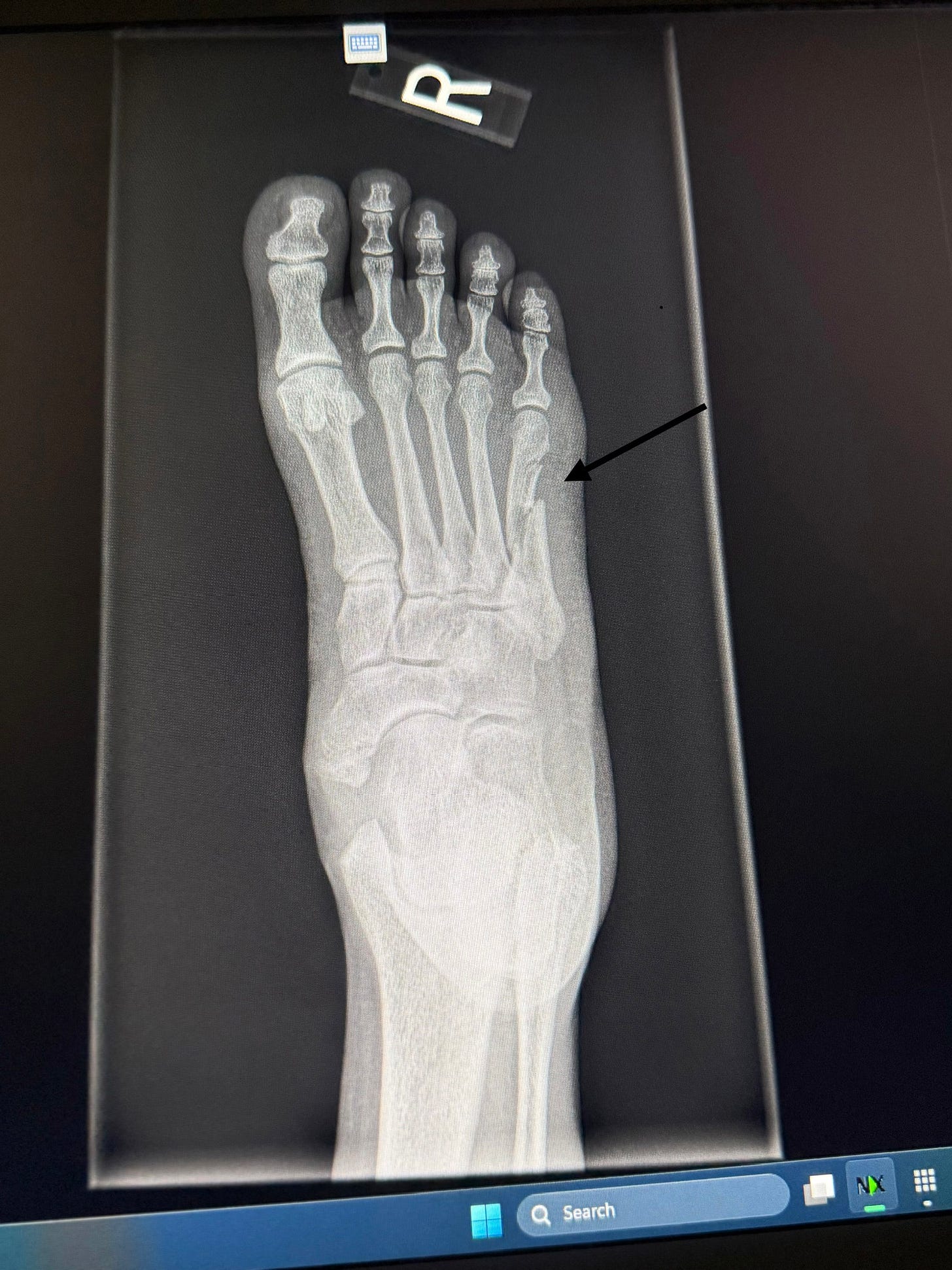 X-ray of a fractured fifth metatarsal bone in the right foot, taken after a fall two weeks before the follow-up blood draw. X-ray of a fractured fifth metatarsal bone in the right foot, taken after a fall two weeks before the follow-up blood draw.