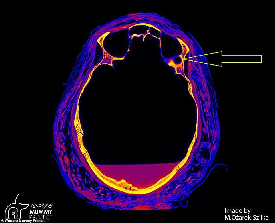 Researchers at the Warsaw Mummy Project in Poland were carrying out a scan of the ancient corpse’s skull when they discovered unusual markings in the bone (indicated here in cross section scan) Researchers at the Warsaw Mummy Project in Poland were carrying out a scan of the ancient corpse’s skull when they discovered unusual markings in the bone (indicated here in cross section scan)