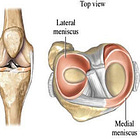 Clinicians Corner | Brace Yourselves - Meniscus Rehab is Coming