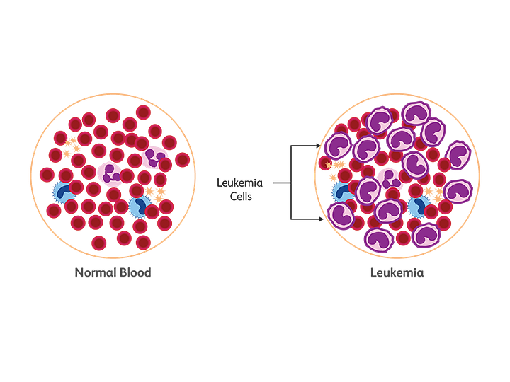 How does leukemia start?