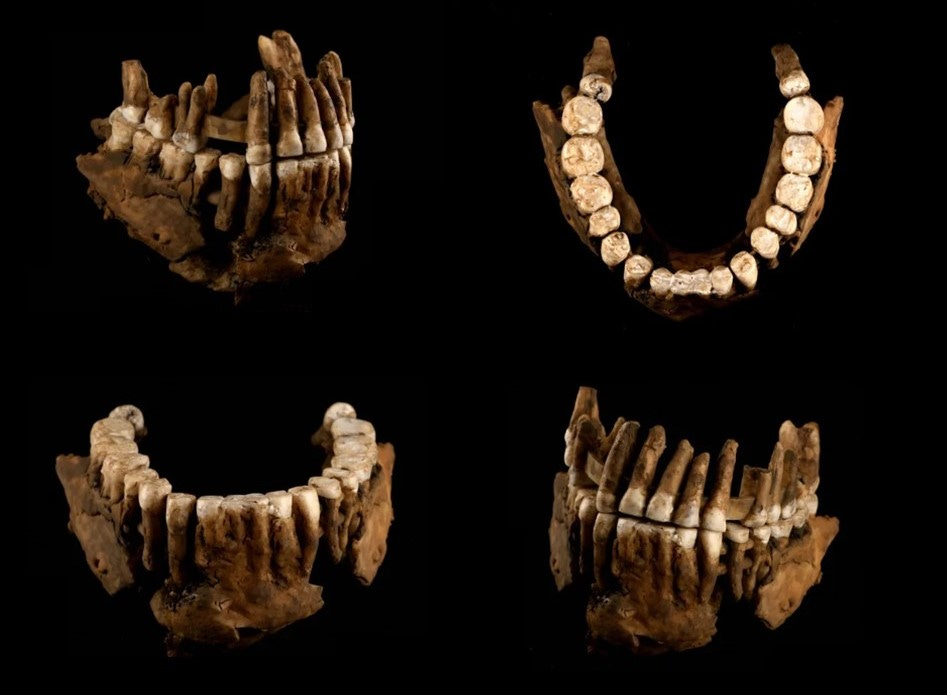 Reconstruction of Thorin's jaw and teeth