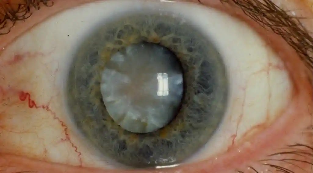 Detailed view of a cloudy cataract formation within the human eye, illustrating lens opacity and its visual impact.
