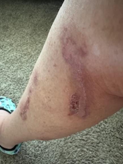 Woman who claims Meghan Markle's bath salts gave her 'catastrophic burns' threatens to sue the duchess for $10m | Daily Mail Online Woman who claims Meghan Markle's bath salts gave her 'catastrophic burns' threatens to sue the duchess for $10m | Daily Mail Online