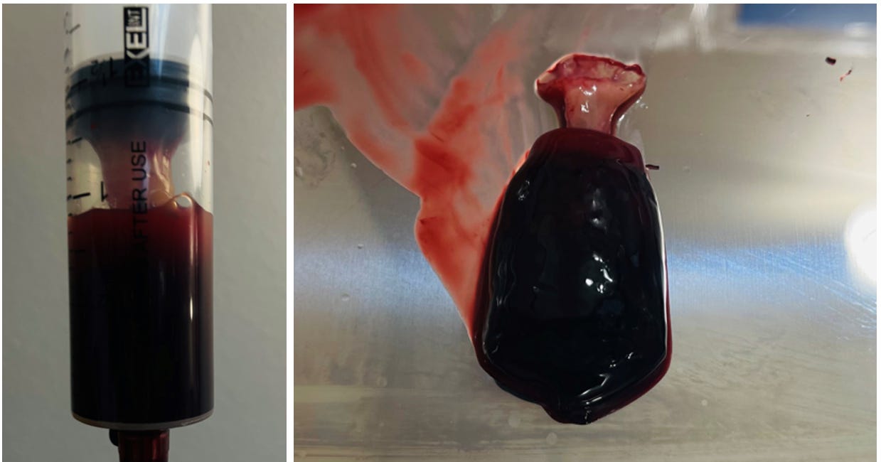Breaking: Nano/Microbot Self Assembly Of Rubbery Clot Filmed In C19 Unvaxxed - Same as Vaxxed and Deceased Clots. Clot Develops Despite Being On Blood Thinners In Patient With Strokes & Heart Attack 