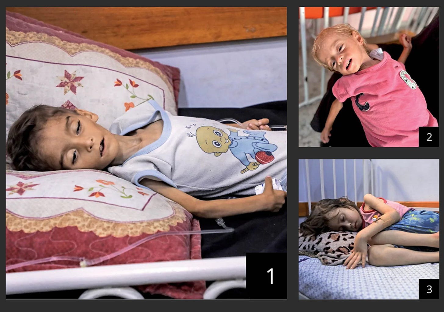 1. A boy photographed at the Patient Friends Association Hospital by a UNICEF volunteer. 2. Sham Qadeeh, 2, weighs 4.4 kilograms. Suffers from a metabolic disease that requires special nutrition, which isn't readily available in the Strip. Photographed a week ago at Nasser Hospital in Khan Yunis. 3. A girl photographed at the end of July at the Patient Friends Association Hospital by a UNICEF representative. 1. A boy photographed at the Patient Friends Association Hospital by a UNICEF volunteer. 2. Sham Qadeeh, 2, weighs 4.4 kilograms. Suffers from a metabolic disease that requires special nutrition, which isn't readily available in the Strip. Photographed a week ago at Nasser Hospital in Khan Yunis. 3. A girl photographed at the end of July at the Patient Friends Association Hospital by a UNICEF representative.