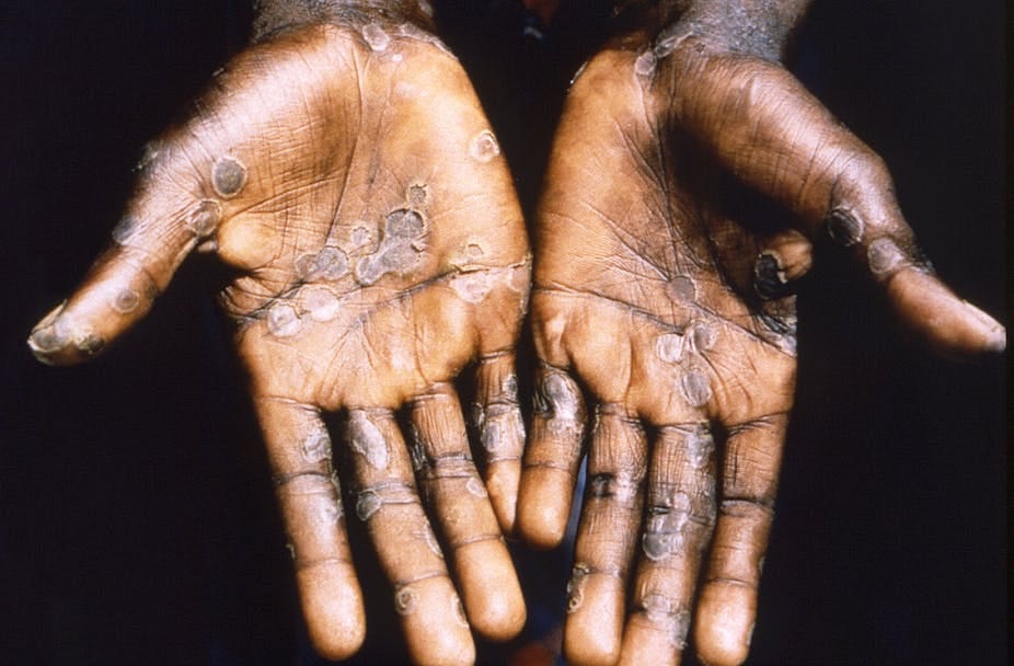Handsd with mpox Handsd with mpox