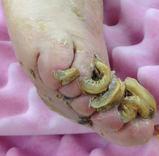 File:Onychogryphosis (1).jpg - Wikimedia Commons File:Onychogryphosis (1).jpg - Wikimedia Commons