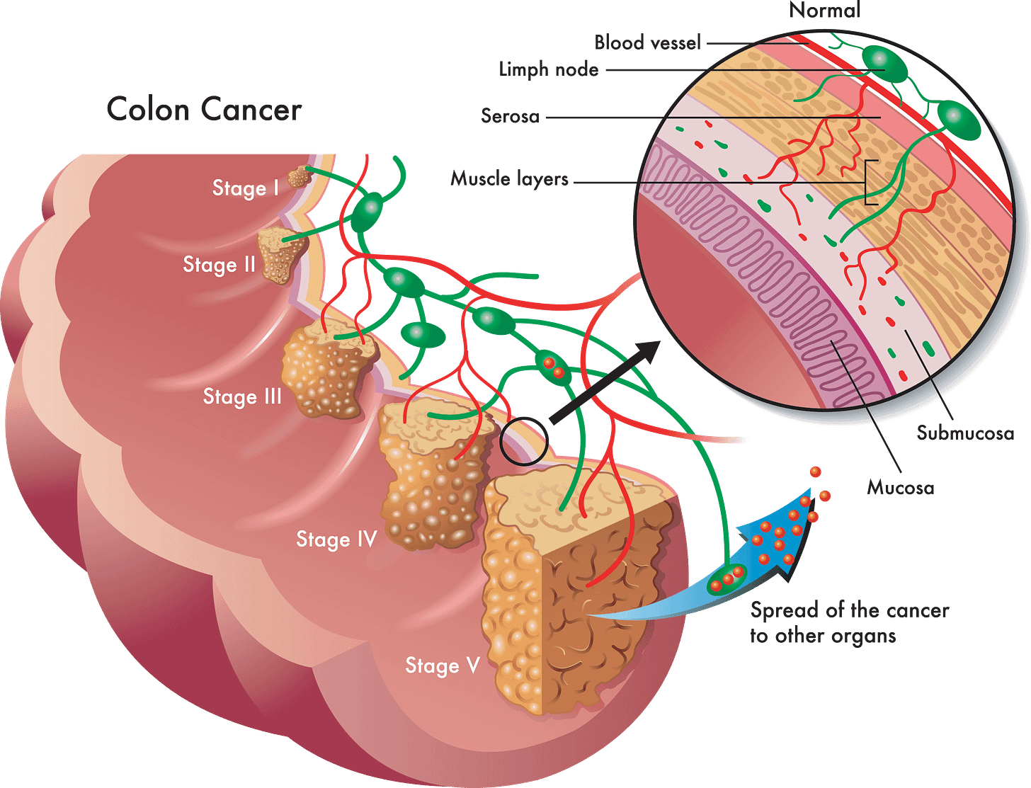 Colon and Rectal Cancer - UHN Colorectal Program