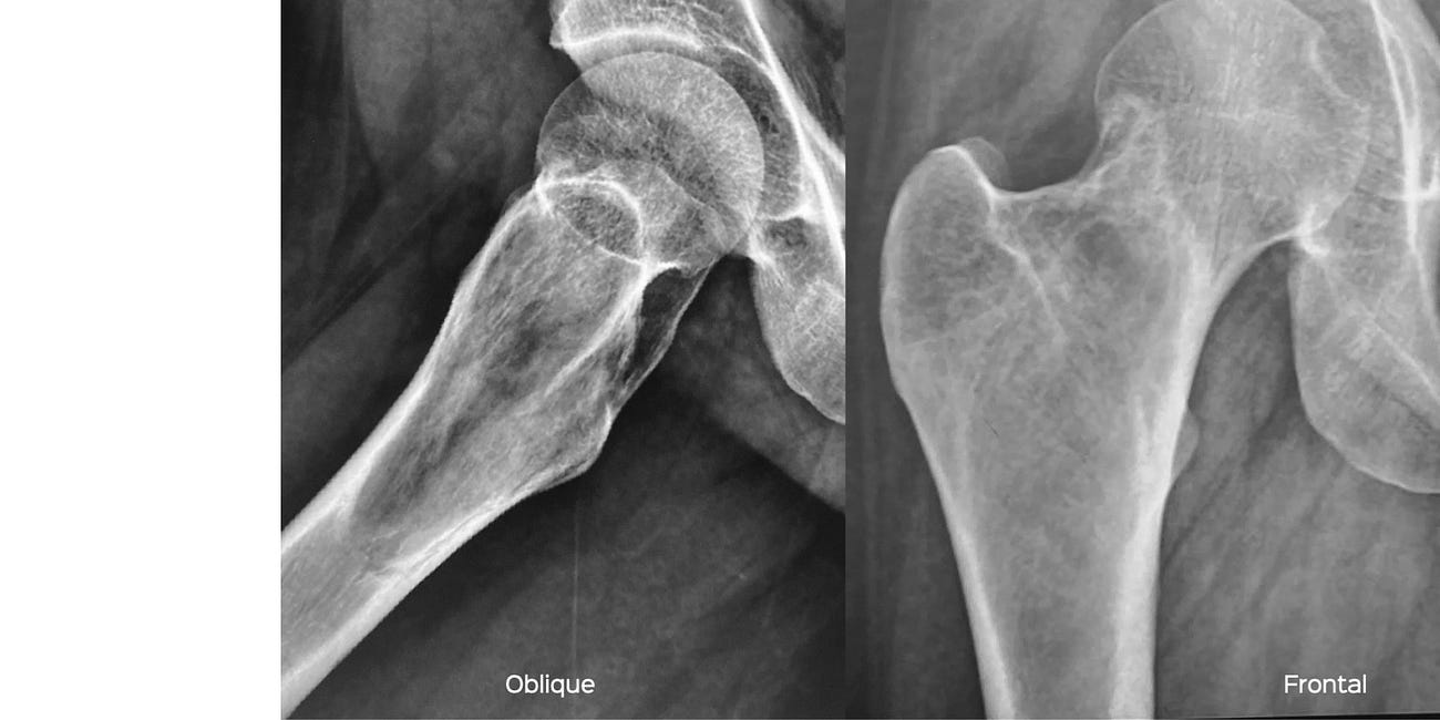 Case 31: The Glassy Proximal Femoral Lesion